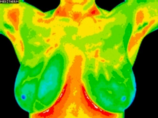BREAST THERMOGRAM
