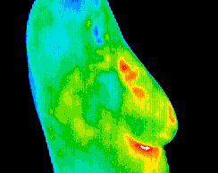 lateral breast thermogram