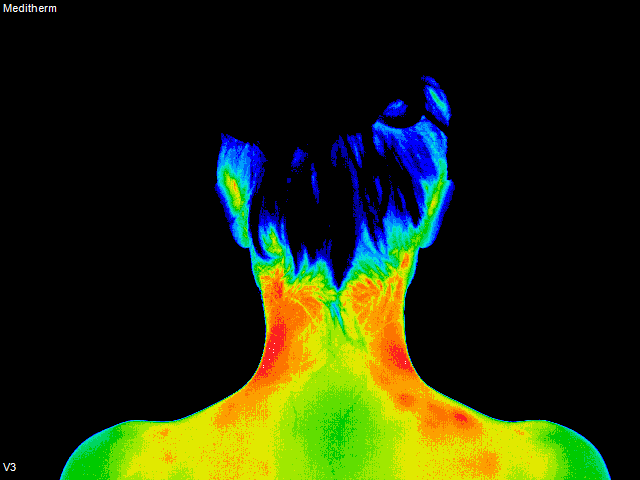 thermography photo of shoulders and neck