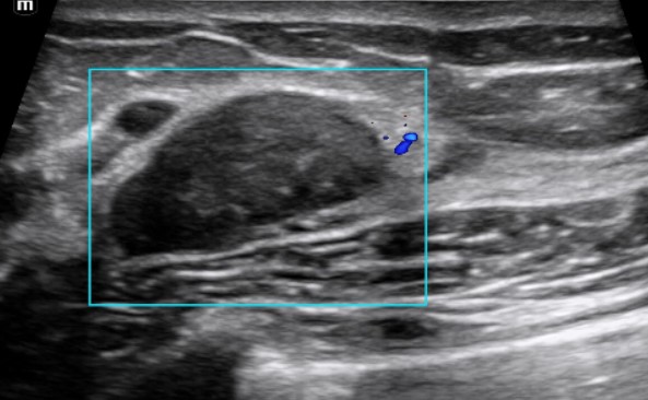 Fibroadenoma with color Doppler Ultrasound