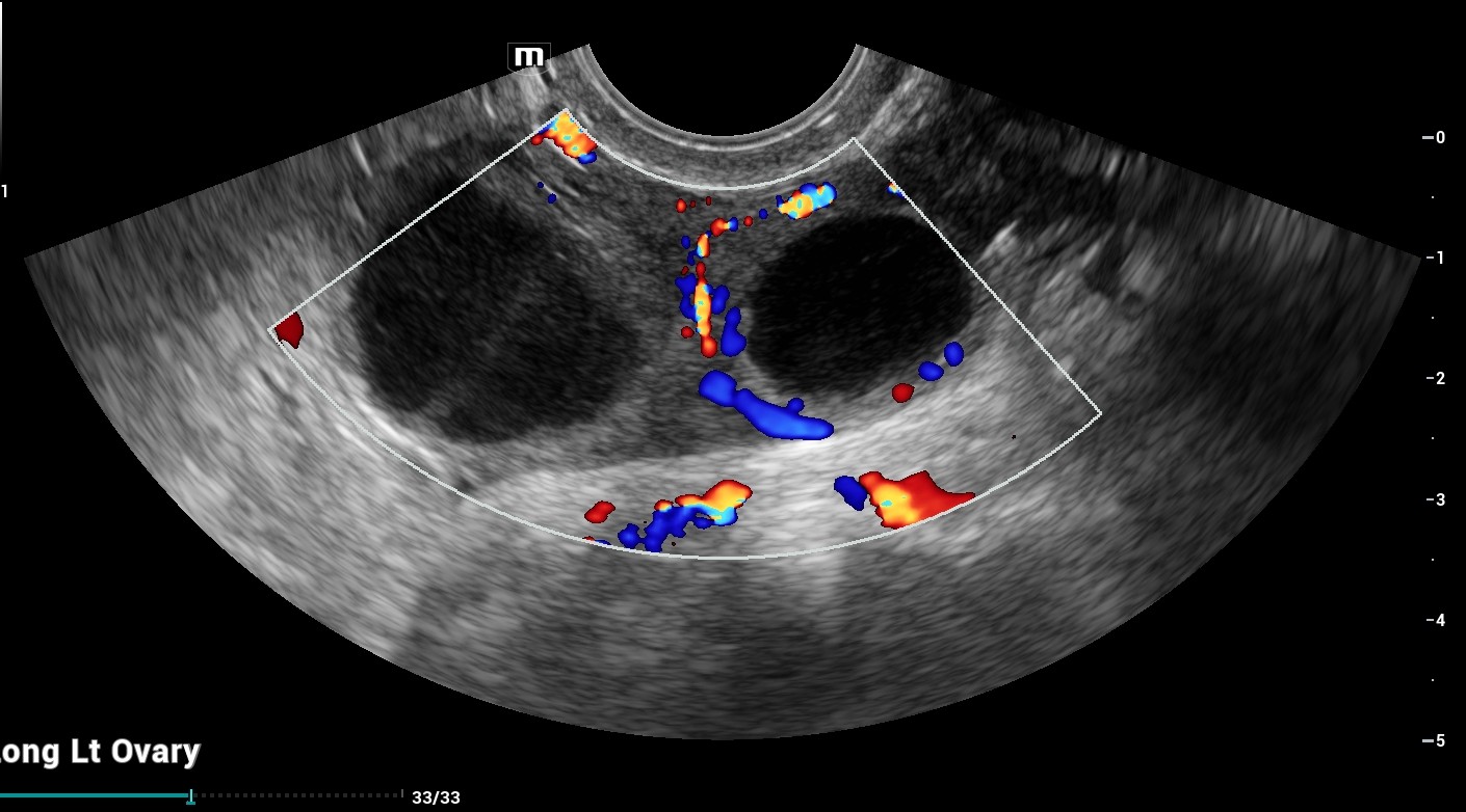 ultrasound ovary with corpeus luteum
