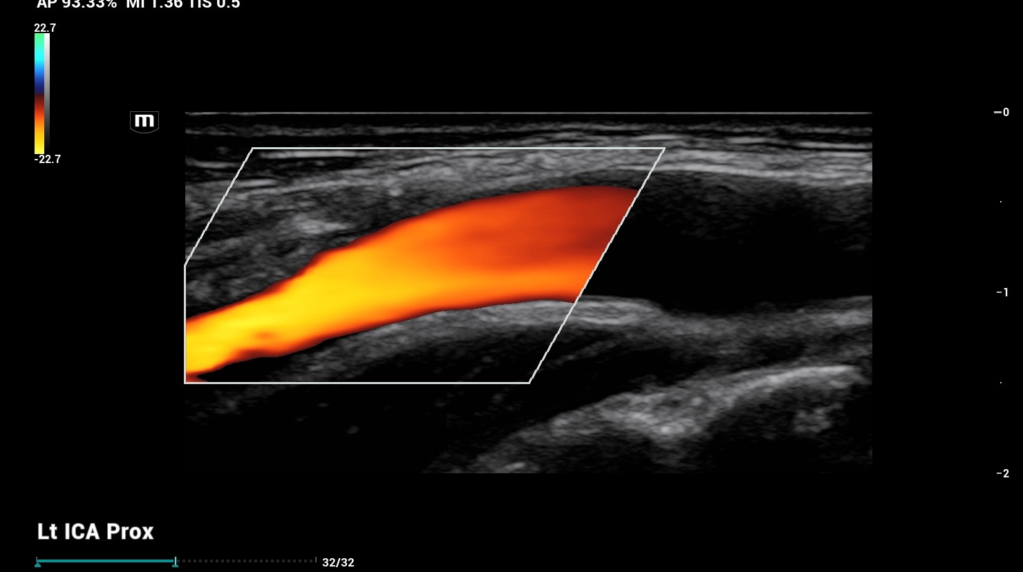 ultrasound of carotid artery 