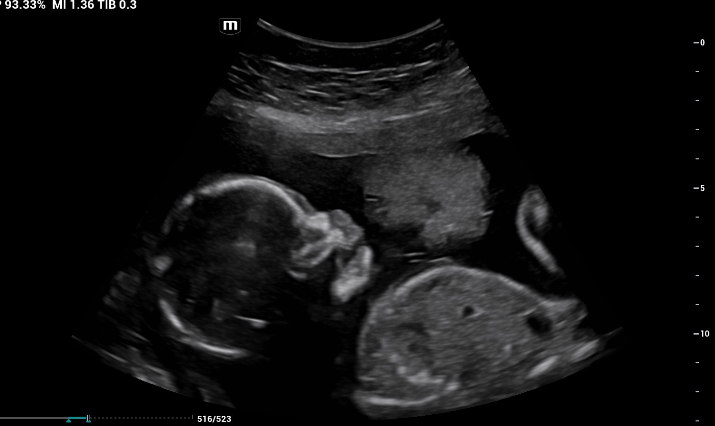 ultrasound of baby