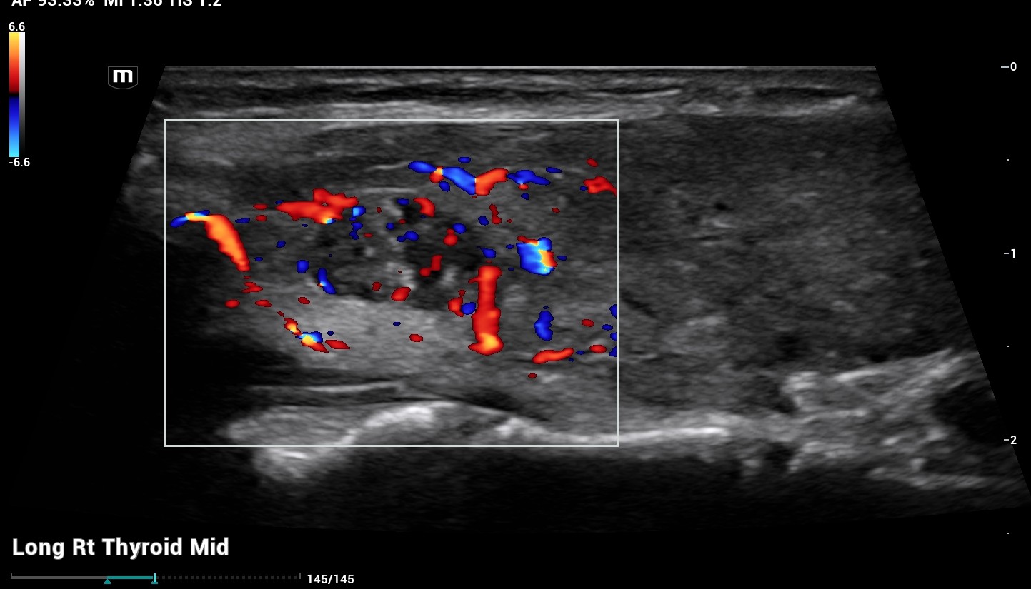 ultrasound of thyroid nodule