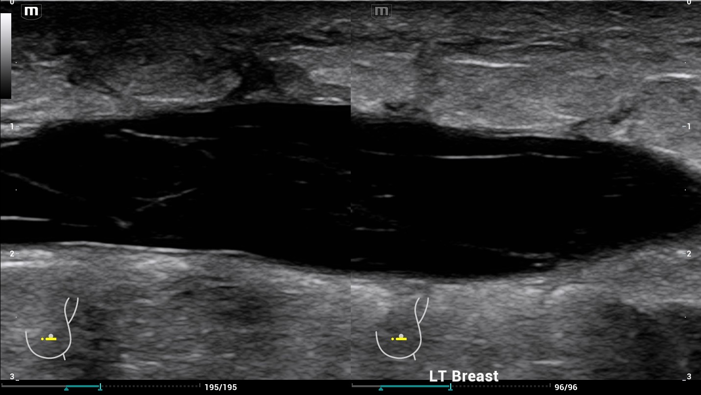 ultrasound of breast fluid collection