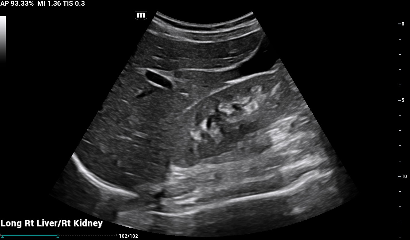 ultrasound of liver and kidney