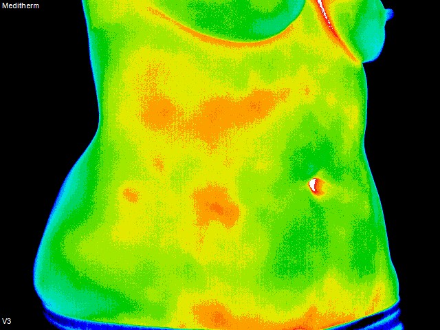 thermography of oblique abdomen
