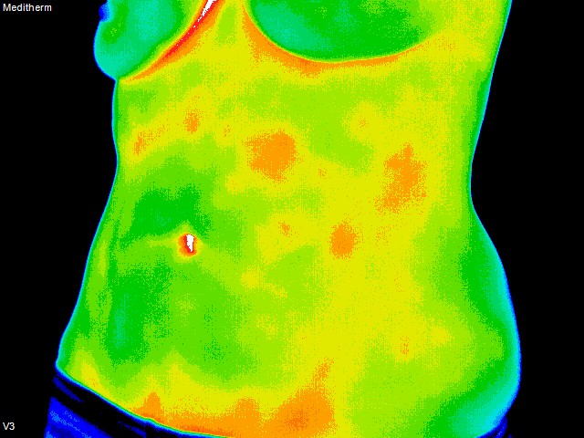 thermography of left abdomen