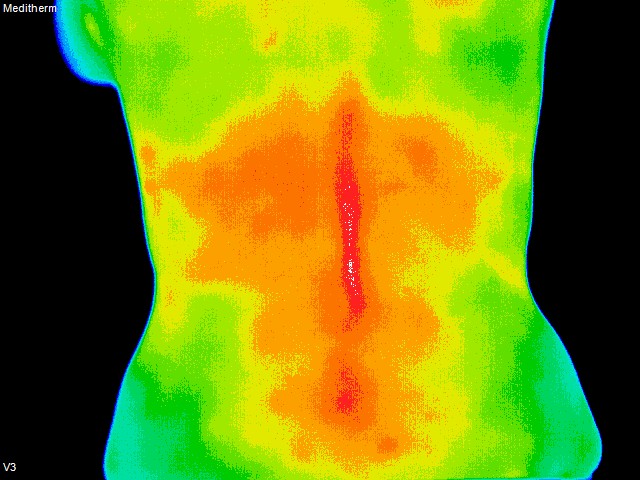 thermography of lower back