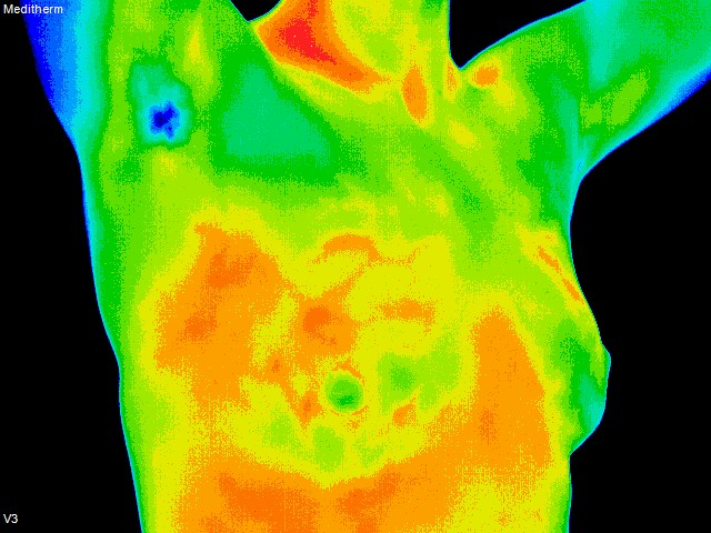thermography photo of breast with significant thermal activity