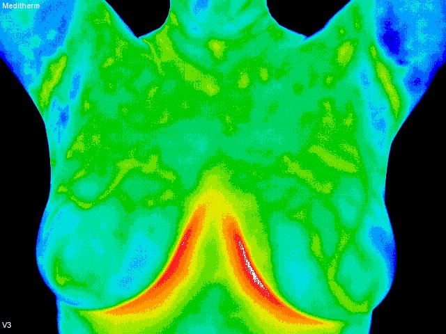 thermography imaging of breasts anterior