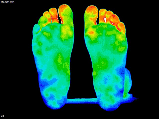 thermography of bottom of feet