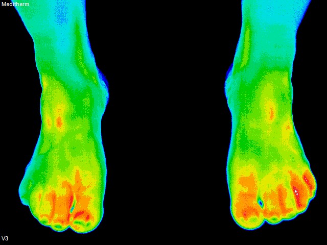 thermography photo of feet