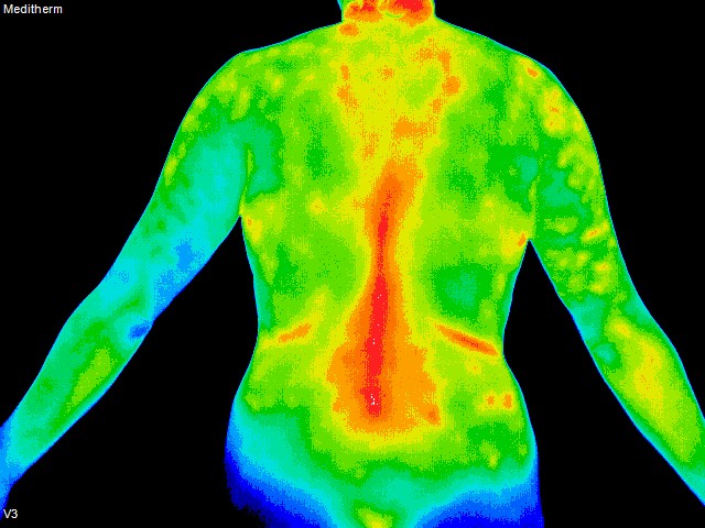 thermography of torso back