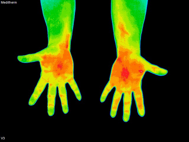 thermography inside of hands
