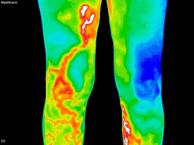 thermography of knees