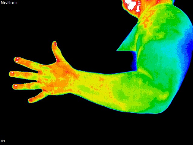 thermography of left arm