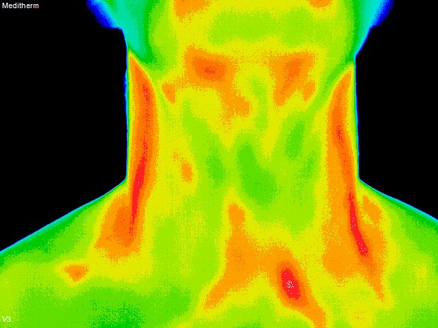 thermography of anterior neck